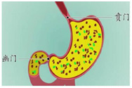 胃铋镁颗粒在反流性食管炎治疗中的应用